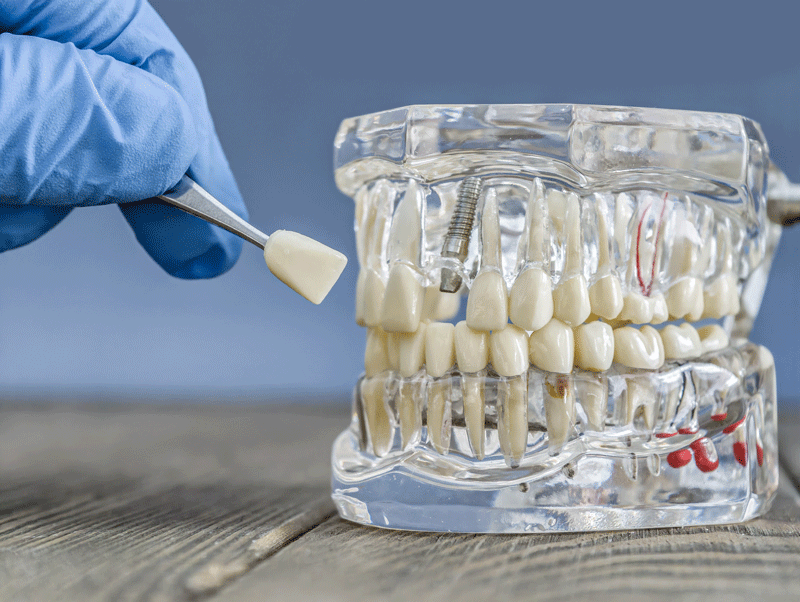Female dentist holding anatomical model of teeth and explaining dental implant procedure to senior patients in clinic.